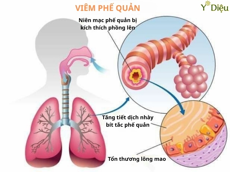 Ho ra đờm vàng có thể do viêm phế quản mãn tính hoặc cấp tính